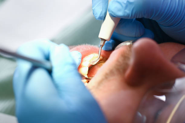 Best Emergency Tooth Extraction in Manche North Shore, CA