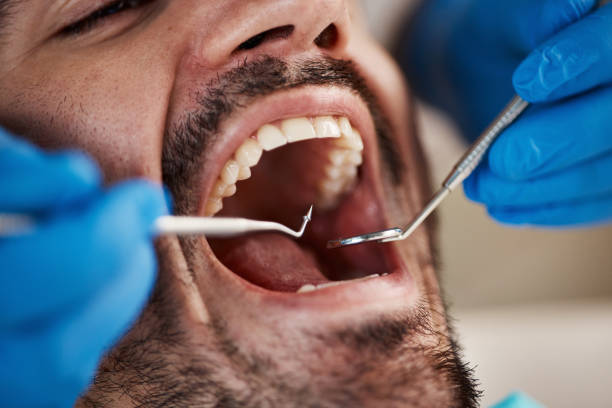 Best Emergency Tooth Extraction in Manche North Shore, CA